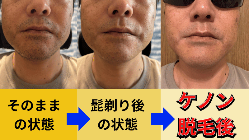 実際のケノン利用した写真
