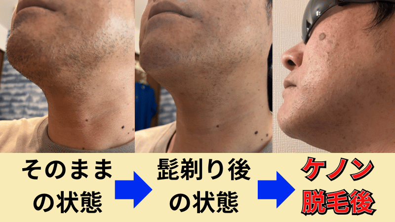 ケノンで脱毛した状態