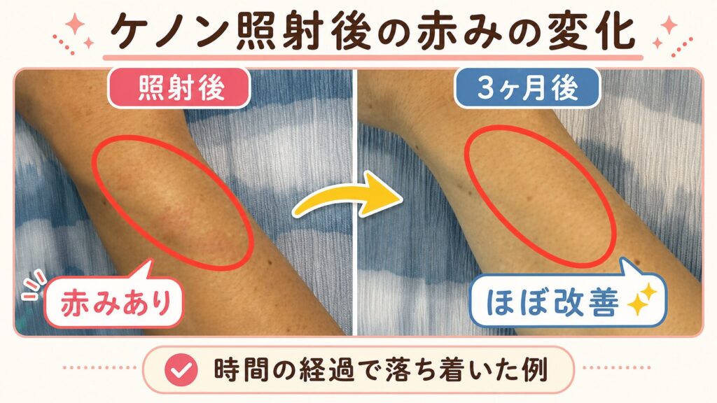 やけどした写真と治るまでの経過