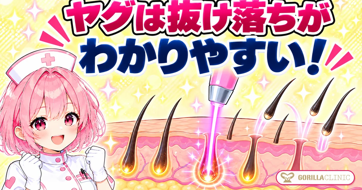 ヤグレーザーは抜け落ちがわかりやすい