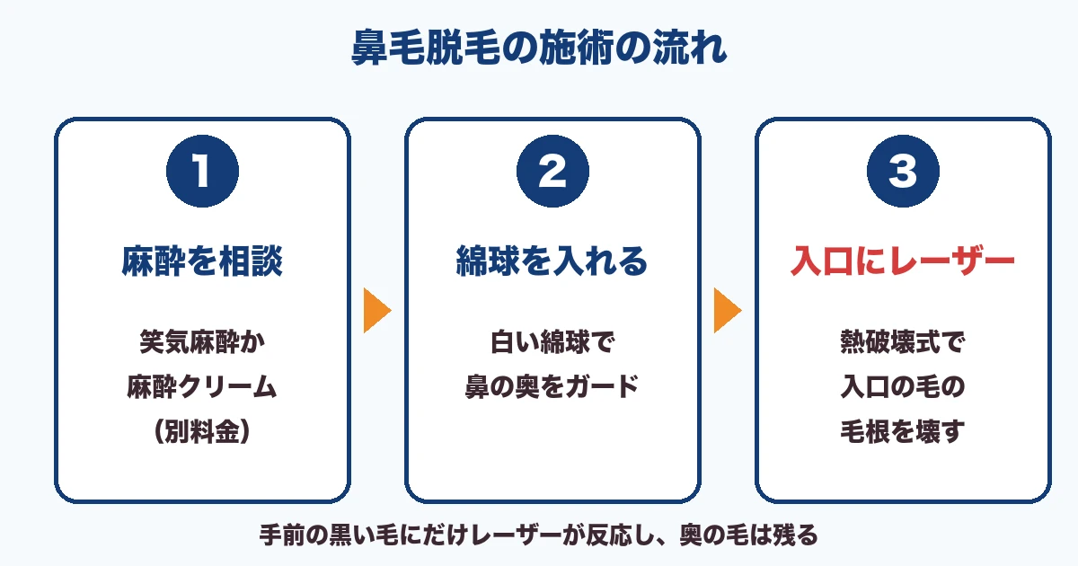麻酔の相談、綿球を入れる、入口にレーザーの3ステップ