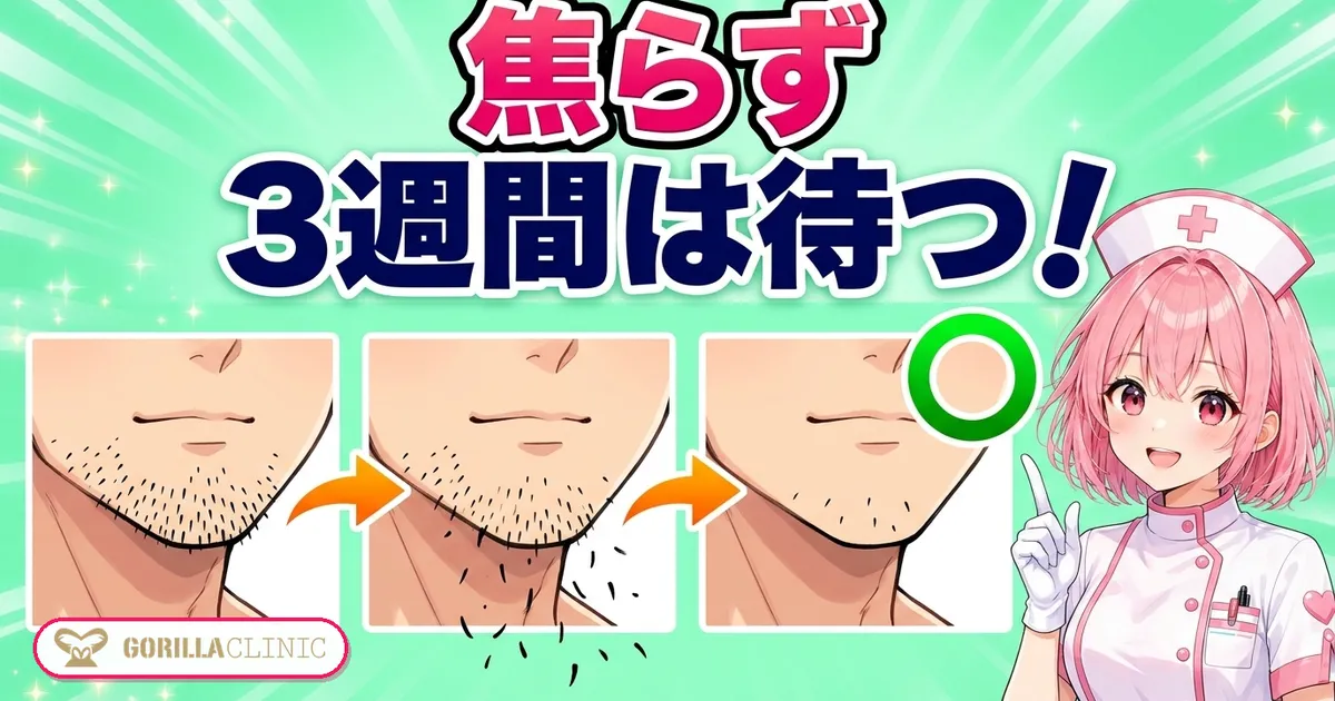 ゴリラクリニックのヒゲ脱毛の経過は焦らず3週間は待つ