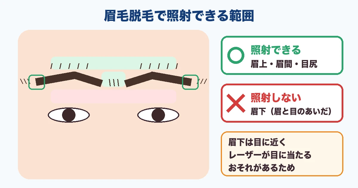 眉毛脱毛で照射できるのは眉上・眉間・目尻、眉下は照射しない